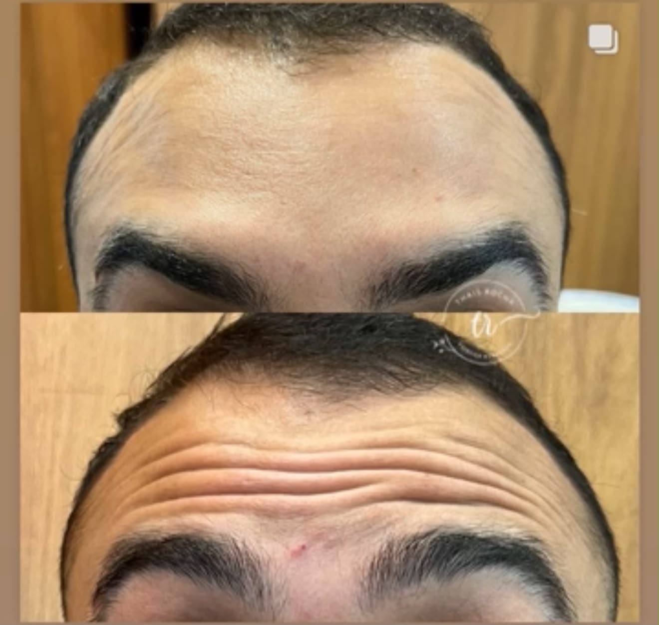 Botox Facial — foto 2