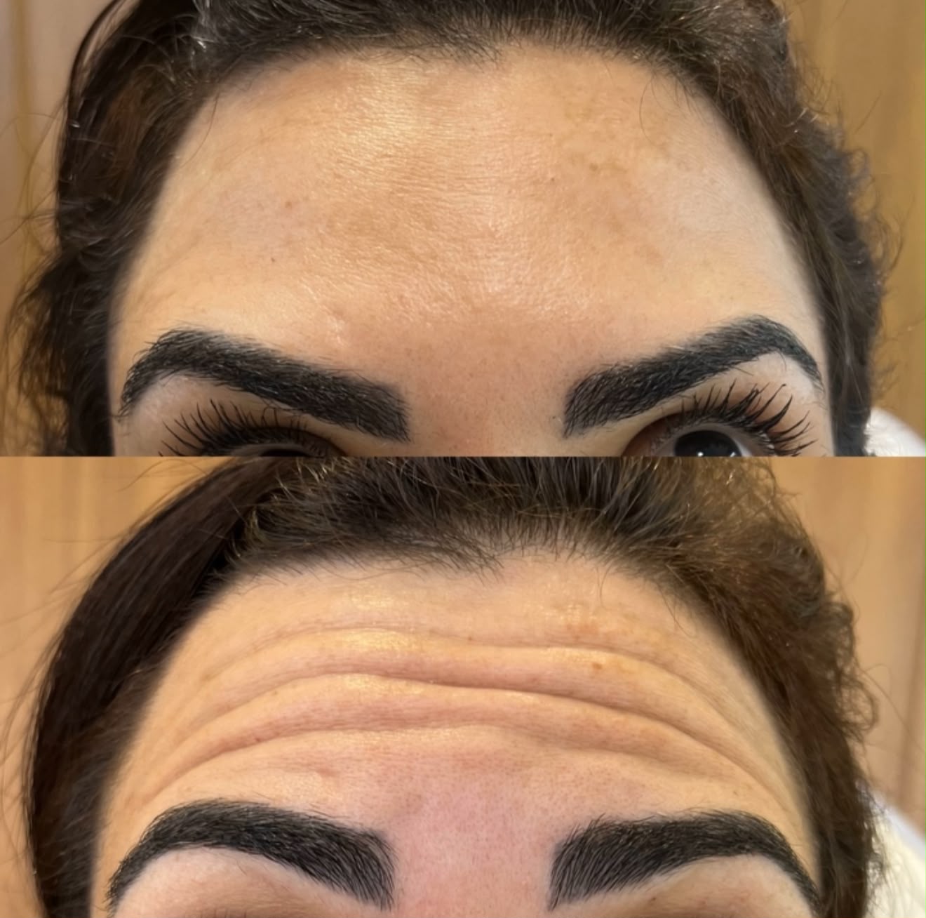 Botox Facial — foto 3