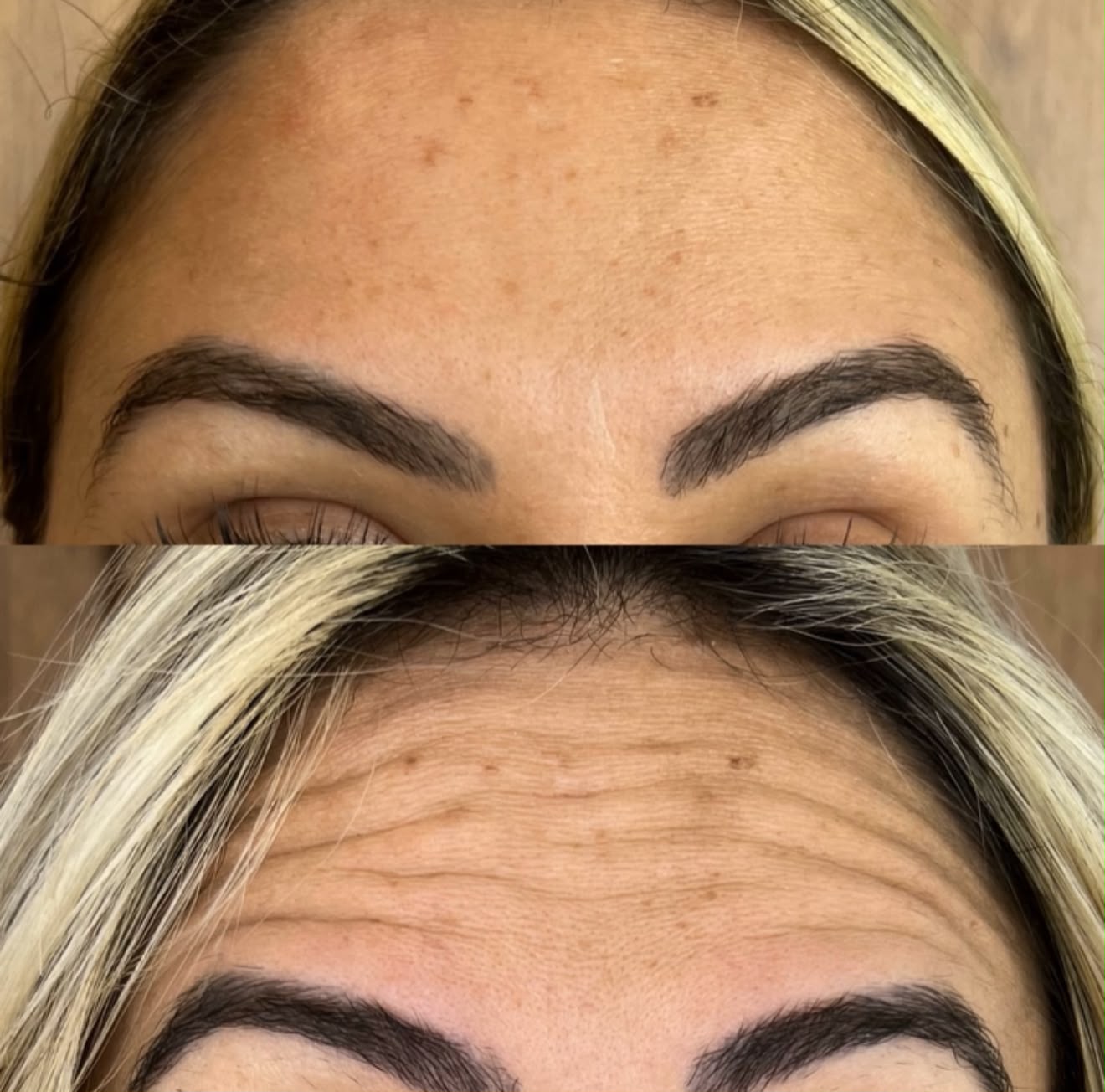 Botox Facial — foto 5