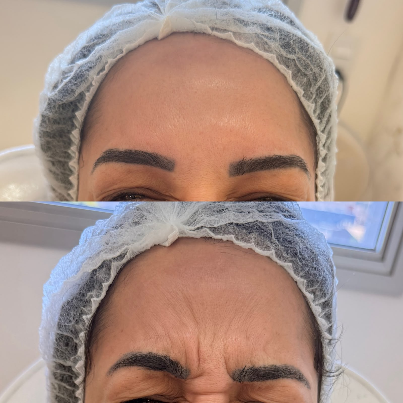Botox Facial — foto 7