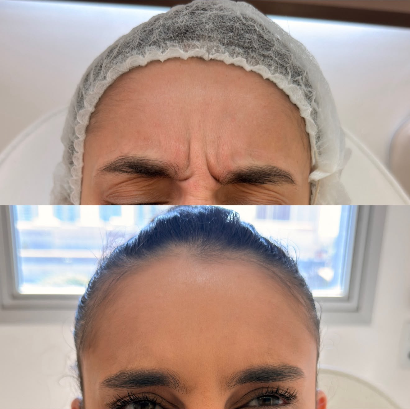 Botox Facial — foto 9
