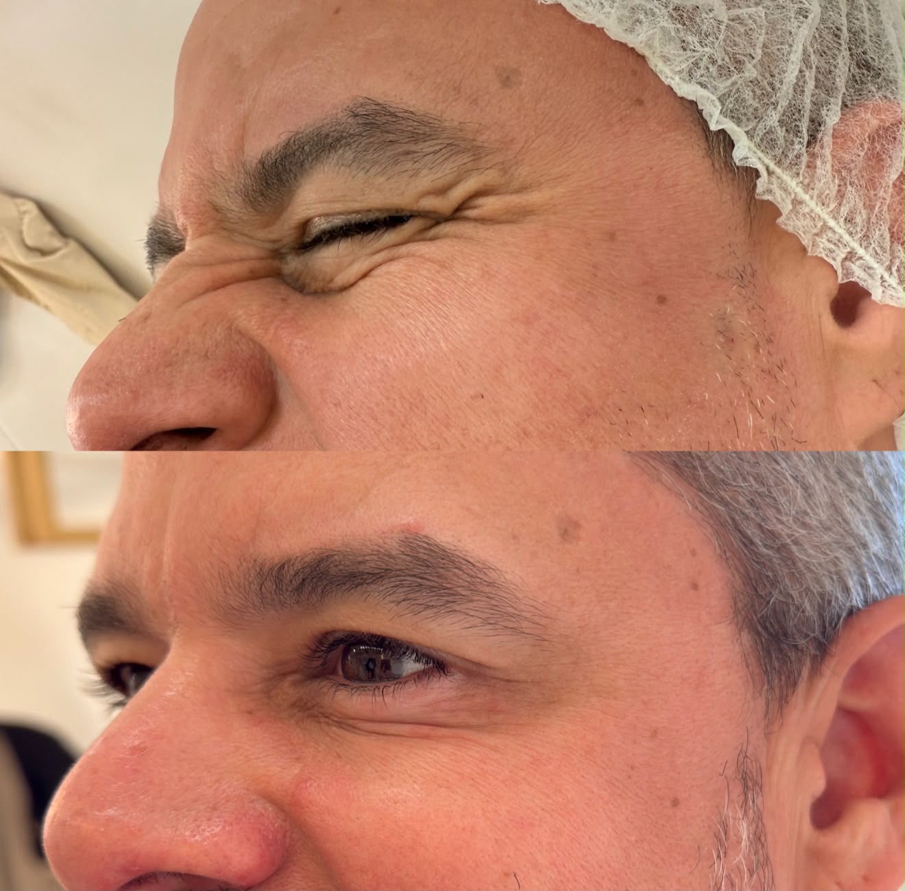 Botox Facial — foto 10