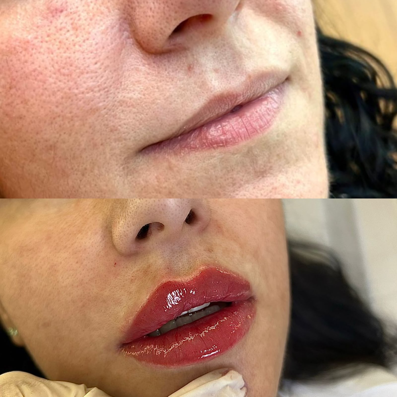 Preenchimento Labial — foto 3
