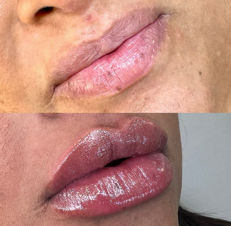 Preenchimento Labial — foto 6