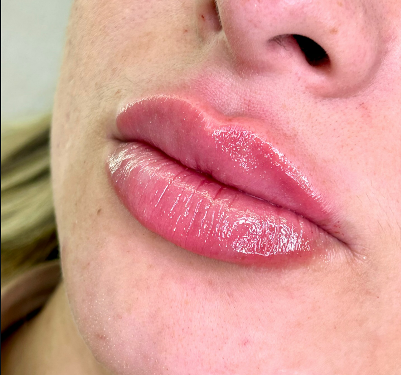Preenchimento Labial — foto 7