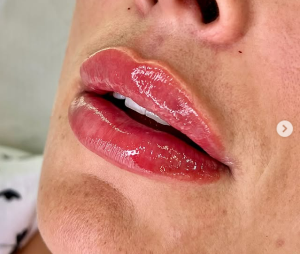 Preenchimento Labial