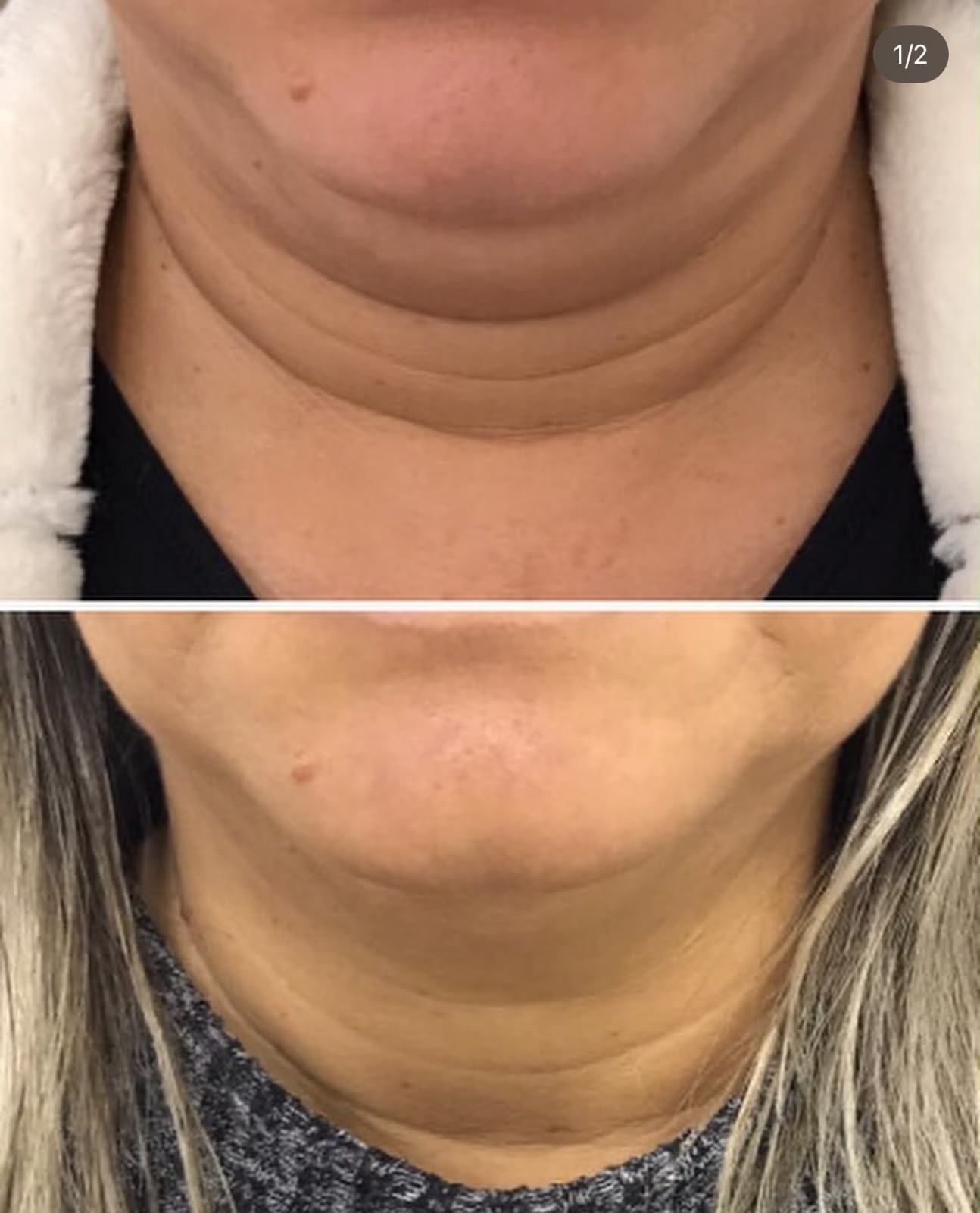 Lipo de Papada sem Cortes — foto 1
