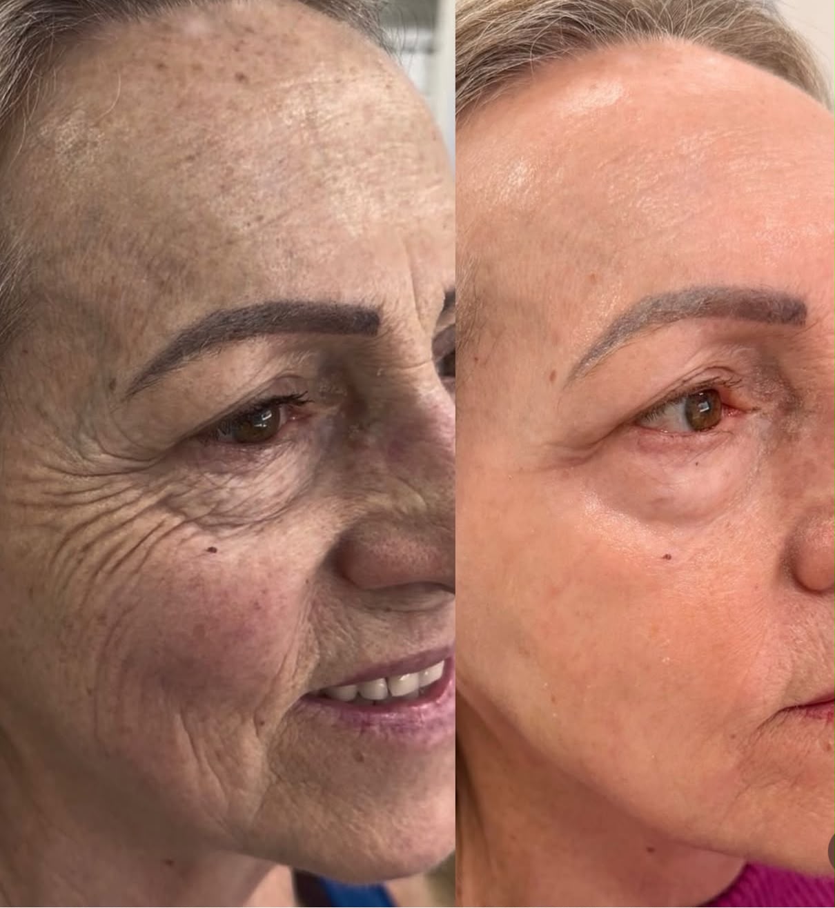 Peeling & Clareamento — foto 2